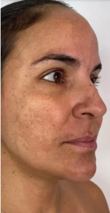 Antes - Juliana Santos